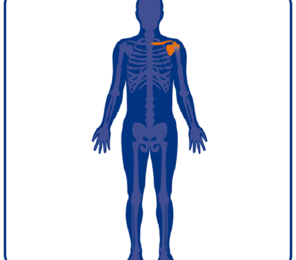 Overzicht klachten aan schouder