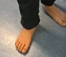 Een siliconen voetprothese is bijna niet van echt te onderscheiden en daarom zeer geschikt om blootvoets mee te lopen. 