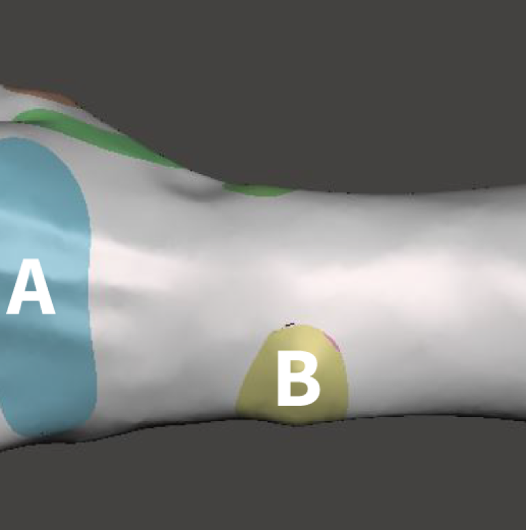 Evaluatie 3D handorthese